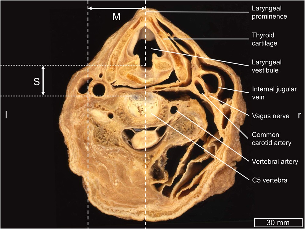 Cervical Vagus Nerve Morphometry And Vascularity In The