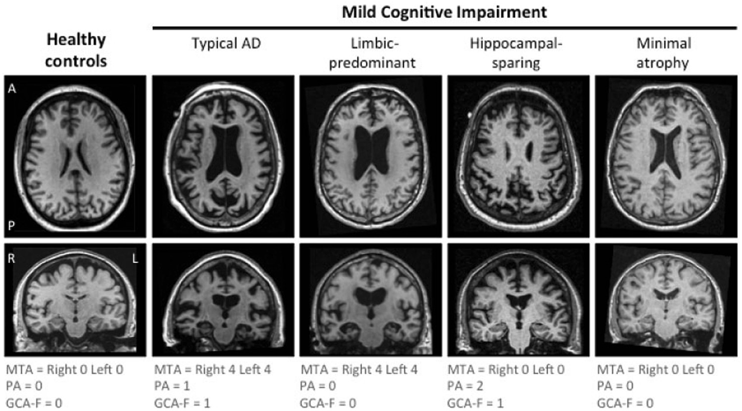 The A/T/N biomarker scheme and patterns of brain atrophy assessed in mild  cognitive impairment | Scientific Reports