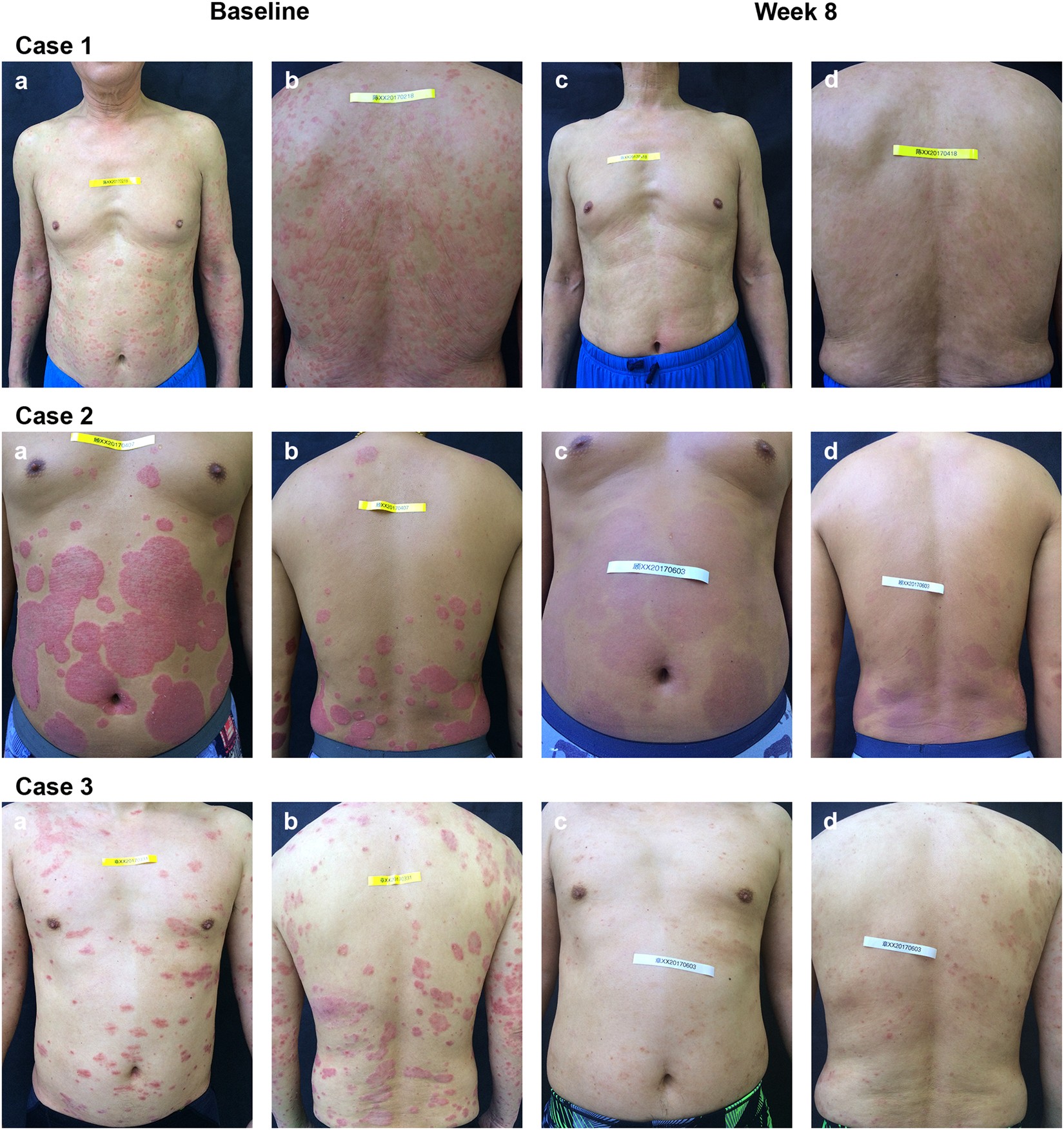 Positive effects of hydrogen-water bathing in patients of psoriasis and  parapsoriasis en plaques | Scientific Reports