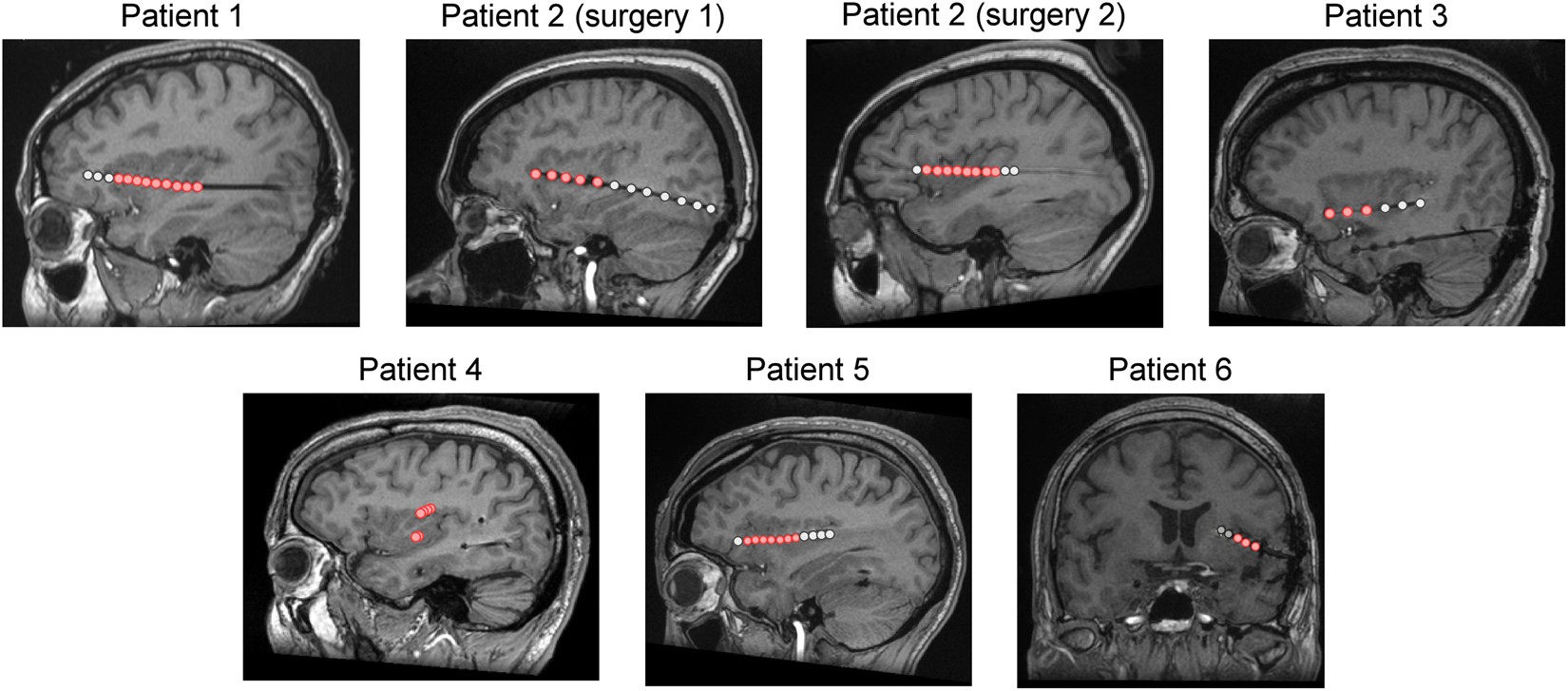 Habituation Of Phase Locked Local Field Potentials And Gamma Band Oscillations Recorded From The Human Insula Scientific Reports