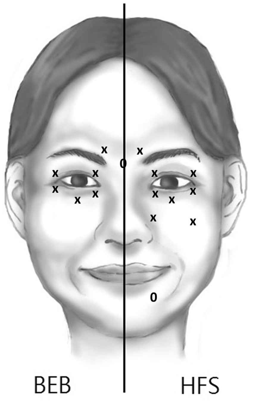 Increase Lipid Tear Thickness After Botulinum Neurotoxin A Injection In Patients With Blepharospasm And Hemifacial Spasm Scientific Reports