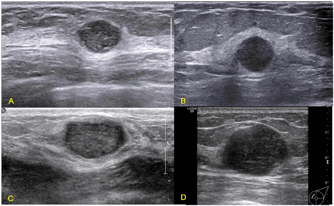 61-year-old female with triple-negative breast cancer of the right