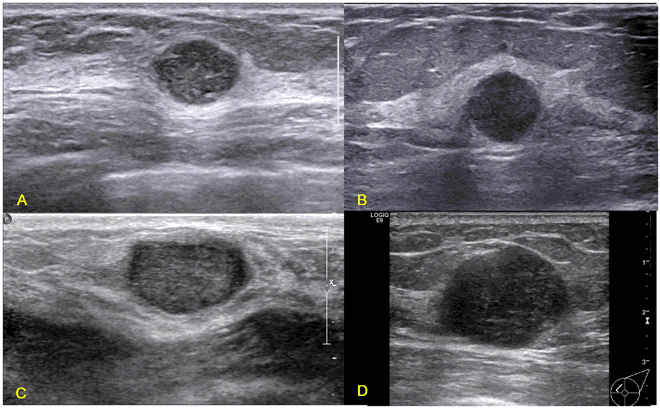 Triple-negative invasive breast carcinoma: the association between