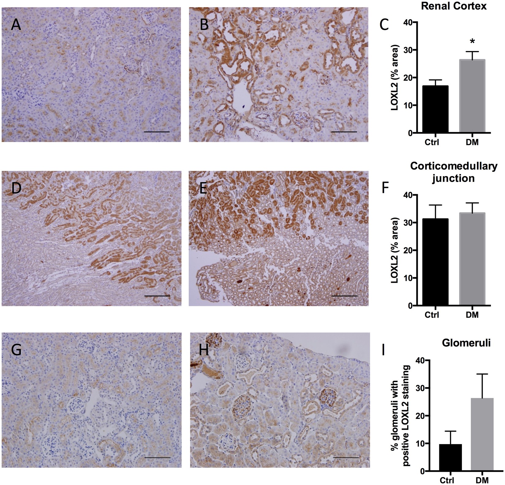 Lysyl Oxidase Like 2 Inhibition Ameliorates Glomerulosclerosis And