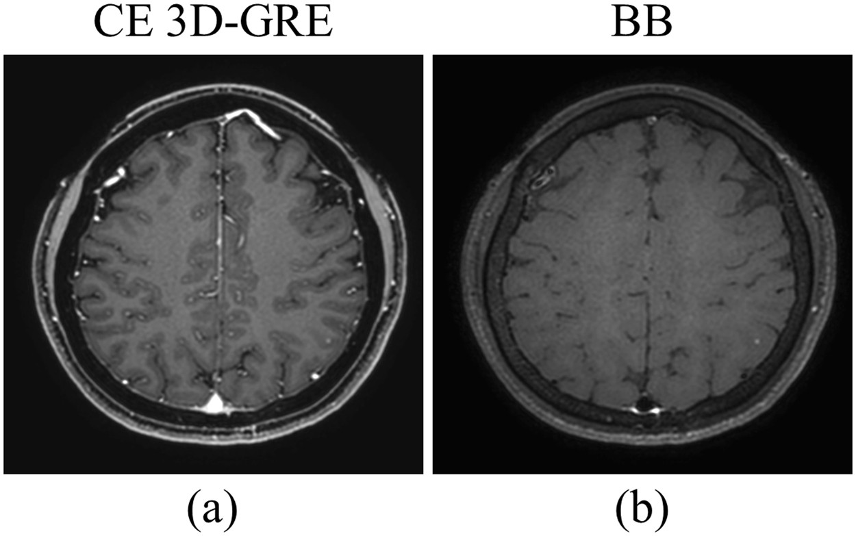 Automated detection of brain metastases on non-enhanced CT using