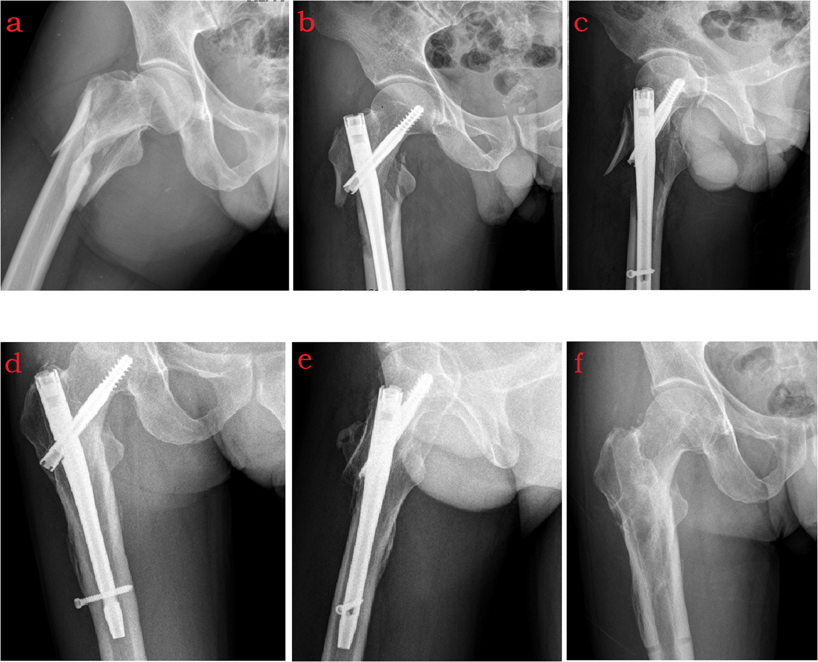 INTERTAN nail versus proximal femoral nail antirotationAsia for  intertrochanteric femur fractures in elderly patients with primary  osteoporosis  topic of research paper in Medical engineering Download  scholarly article PDF and read for