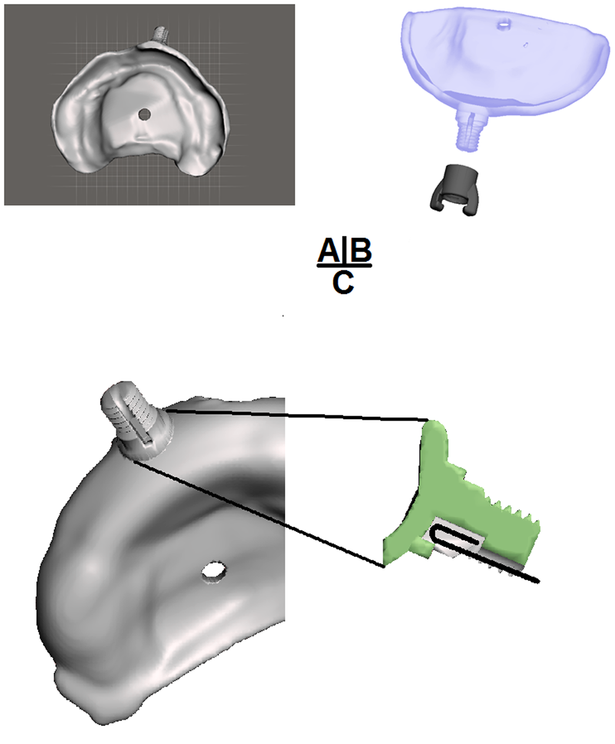 Facilitating Cad Cam Nasoalveolar Molding Therapy With A Novel Click Facilitating Cad Cam Nasoalveolar Molding Therapy With A Novel Click In System For Nasal Stents Ensuring Quick And User Friendly Chairside Stent