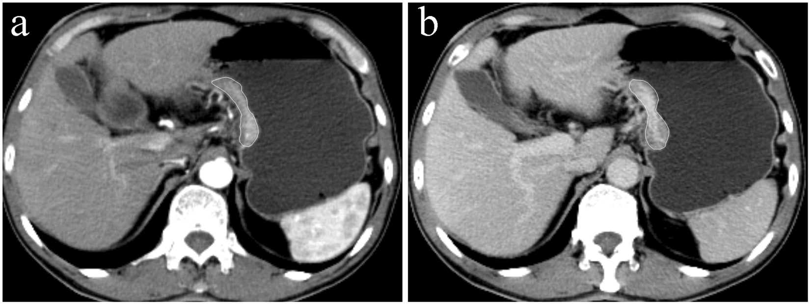 Cancer gastric (de stomac) - Tot ce trebuie să ştii | Cancer Gastric cancer on ct