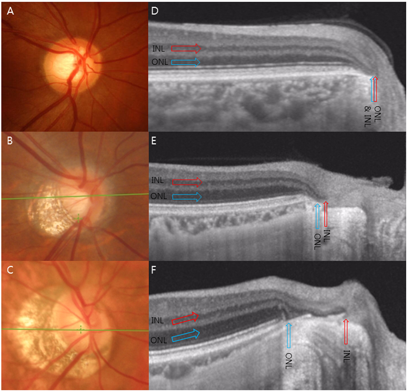 Transverse Separation Of The Outer Retinal Layer At Peripapillary In Glaucomatous Myopes Transverse Separation Of The Outer Retinal Layer At Peripapillary In Glaucomatous Myopes