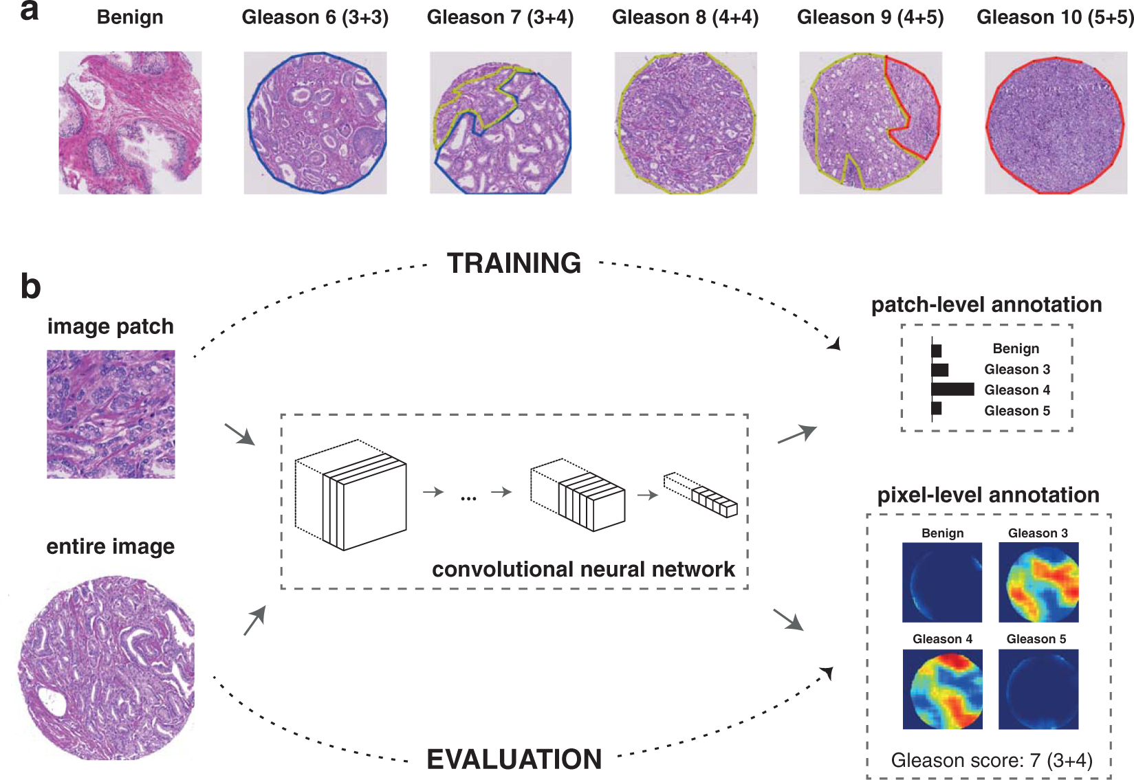 Automated Gleason grading of prostate cancer tissue microarrays via deep  learning | Scientific Reports