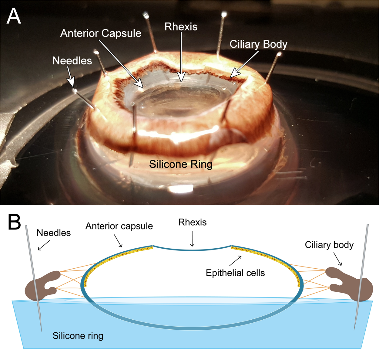 Modified dark-field image capsular bags implanted with (A) an Alcon... |  Download Scientific Diagram