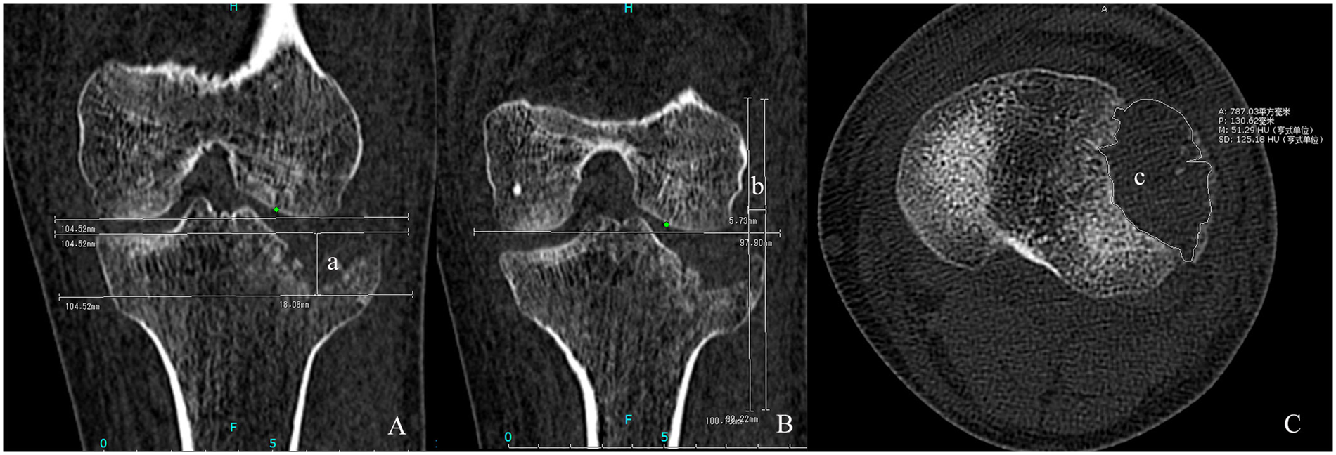 Incidence And Radiological Predictors Of Concomitant