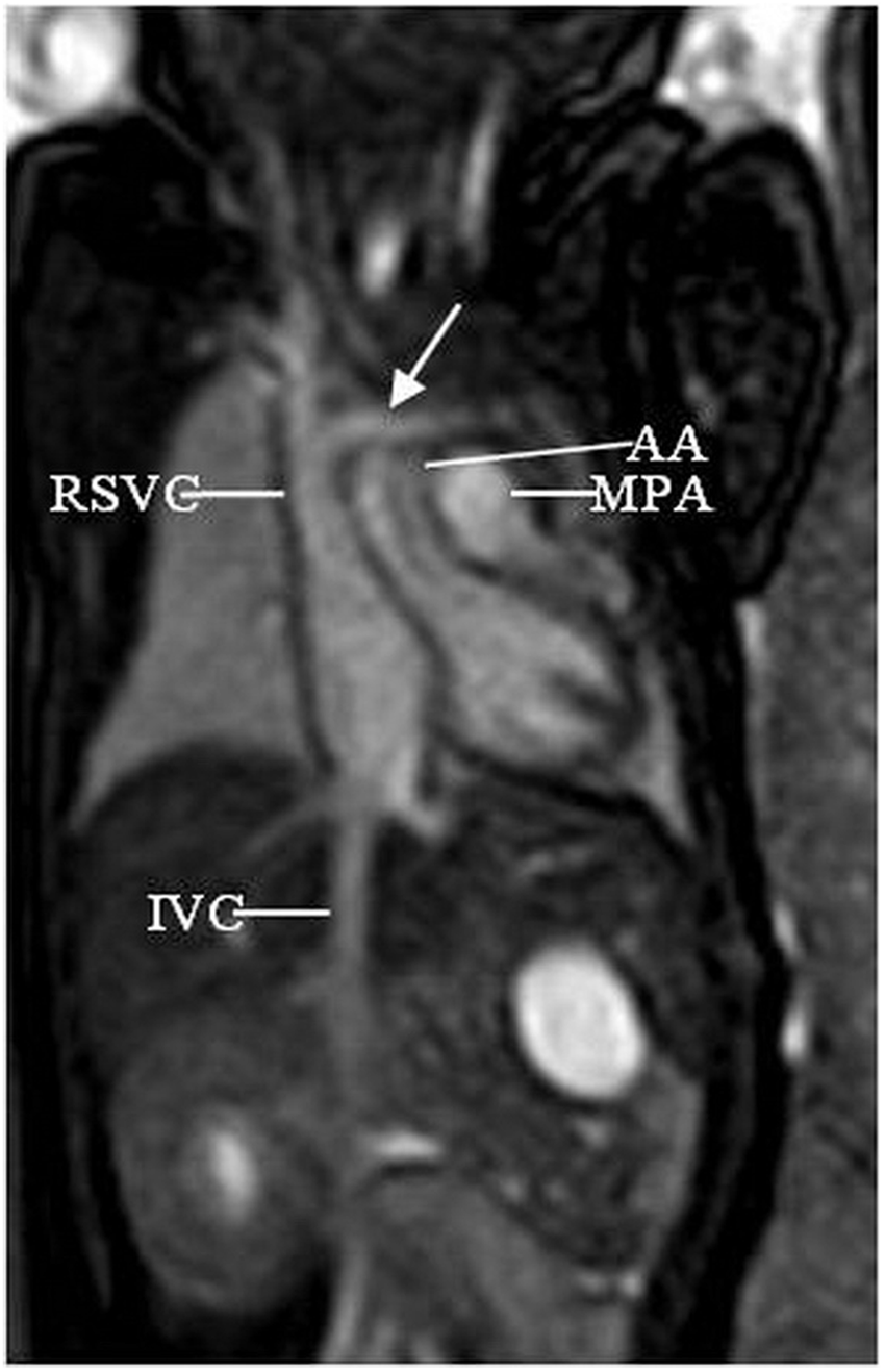 Mr Imaging Of Subaortic And Retroesophageal Anomalous