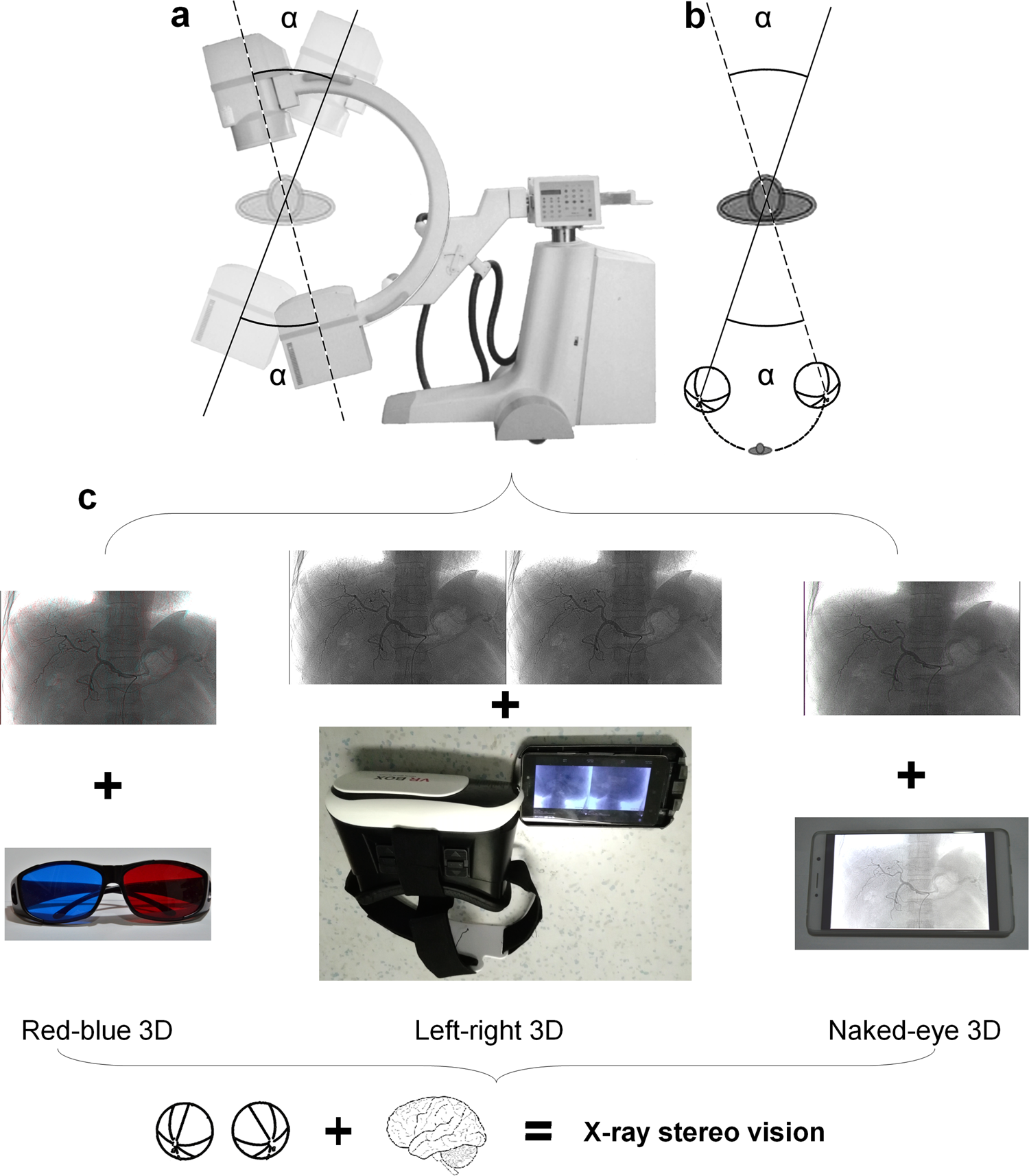 Realization of real-time X-ray stereoscopic vision during interventional  procedures | Scientific Reports