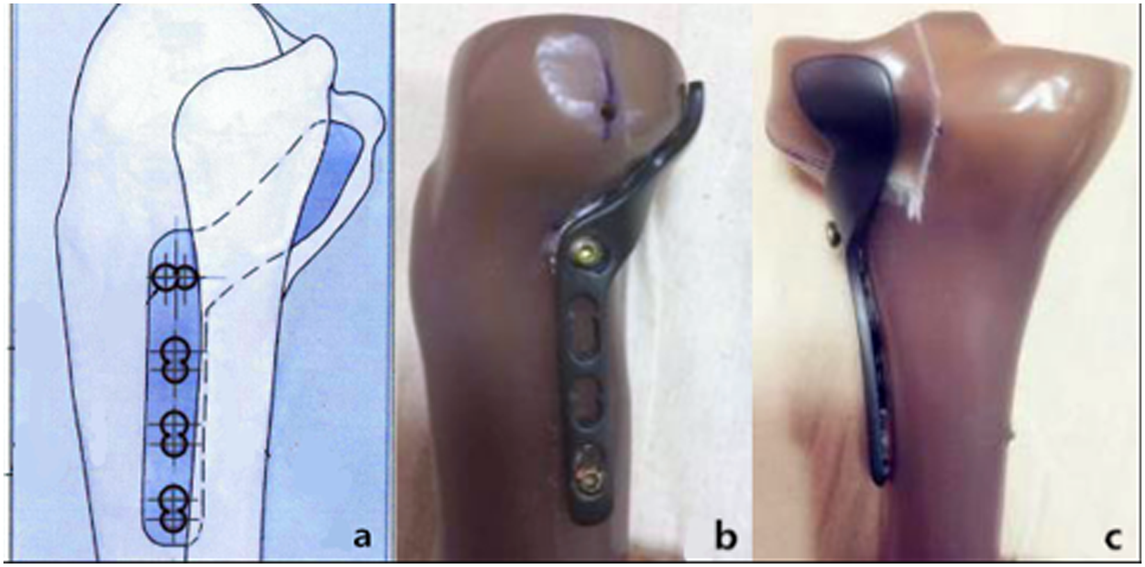 A Novel Design Of A Plate For Posterolateral Tibial Plateau