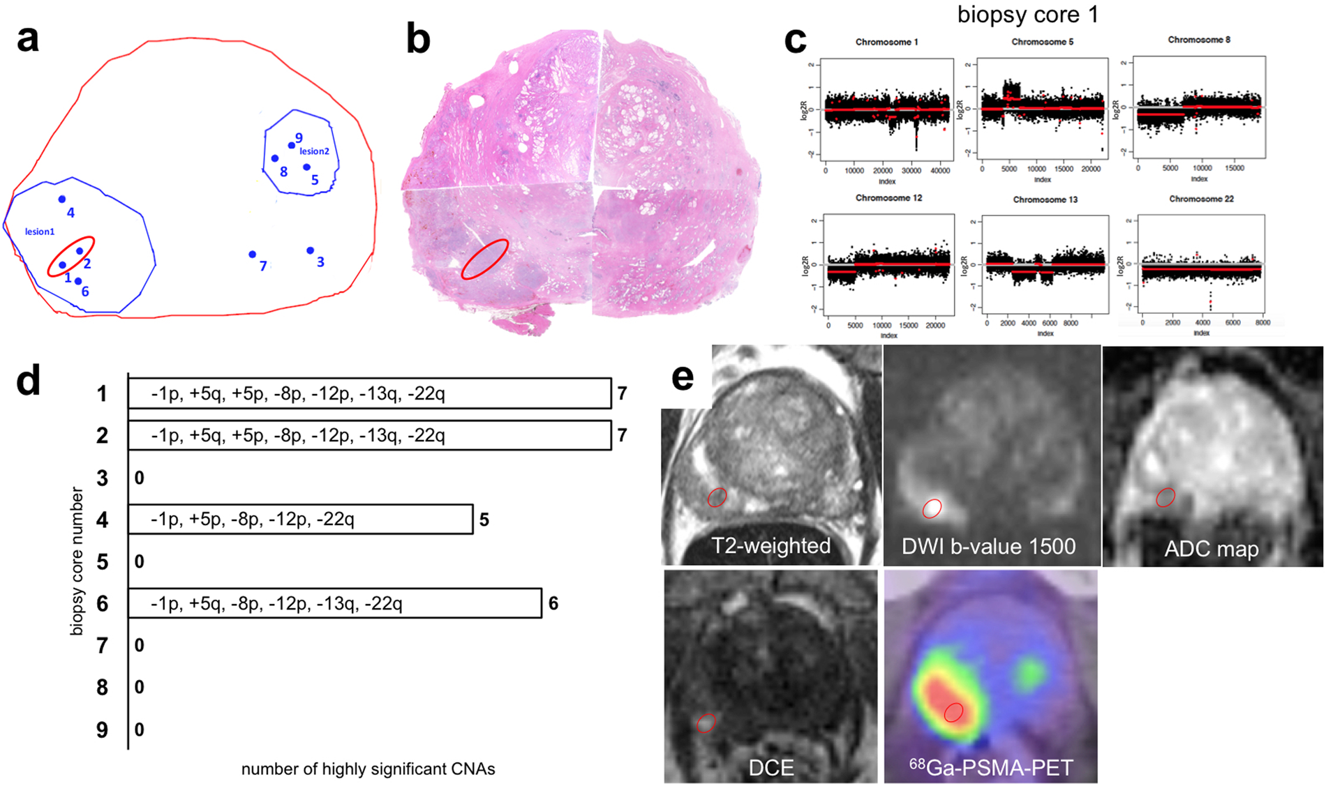 Correlation Between Genomic Index Lesions And Mpmri And 68 - 