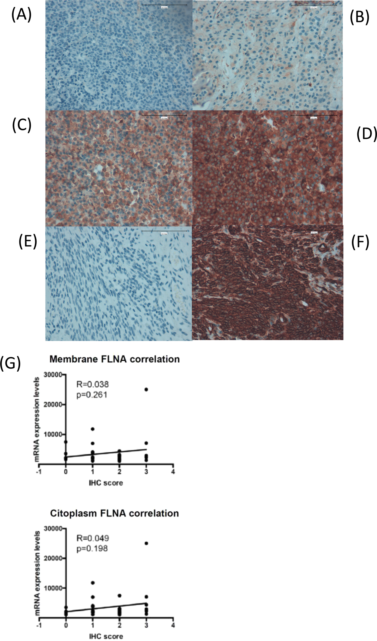Clinical Significance Of Filamin A In Patients With Acromegaly And Filamin A In Patients With Acromegaly