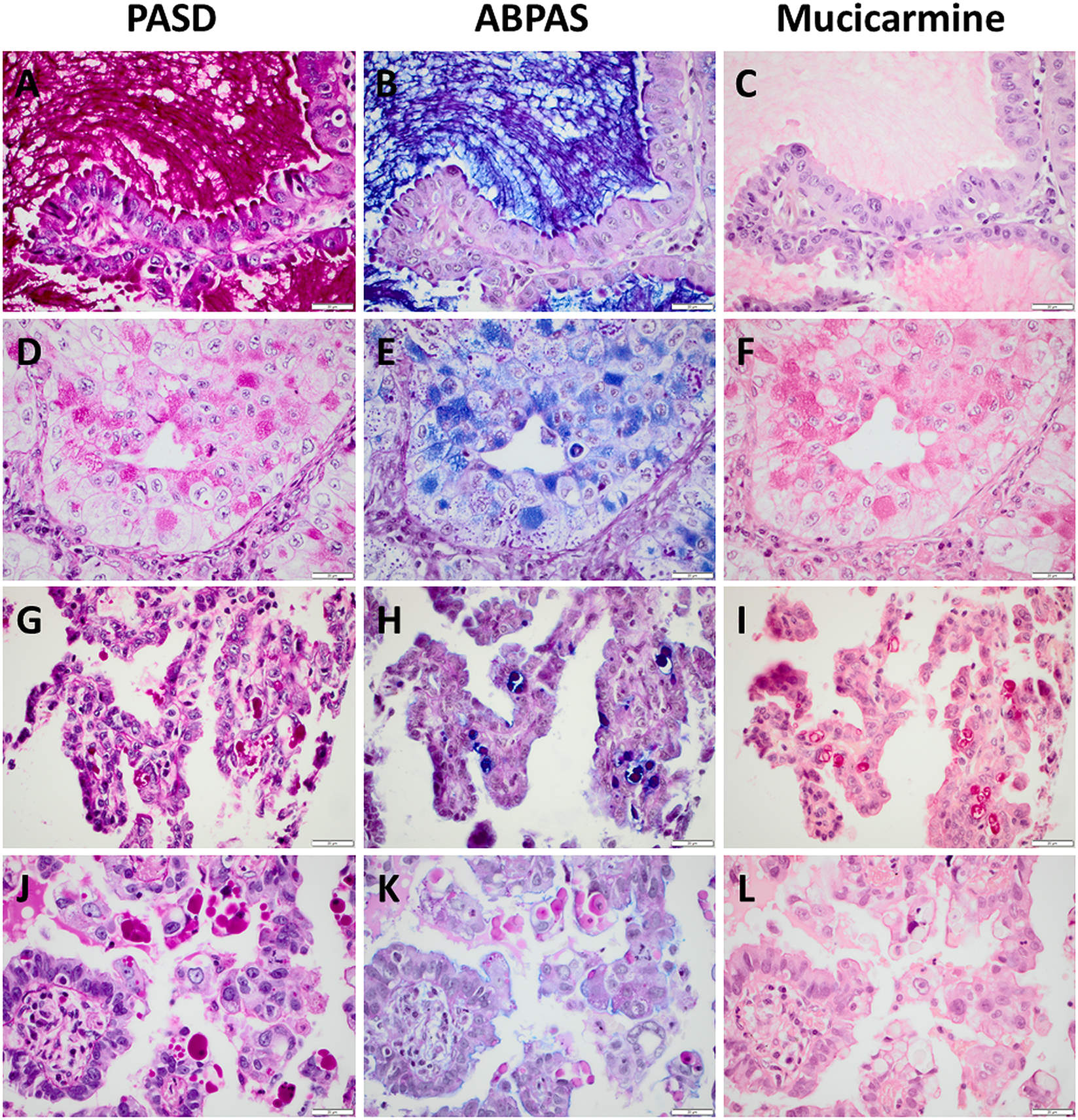 Mucin Staining Is Of Limited Value In Addition To Basic Immunohistochemical Analyses In The Diagnostics Of Non Small Cell Lung Cancer Scientific Reports