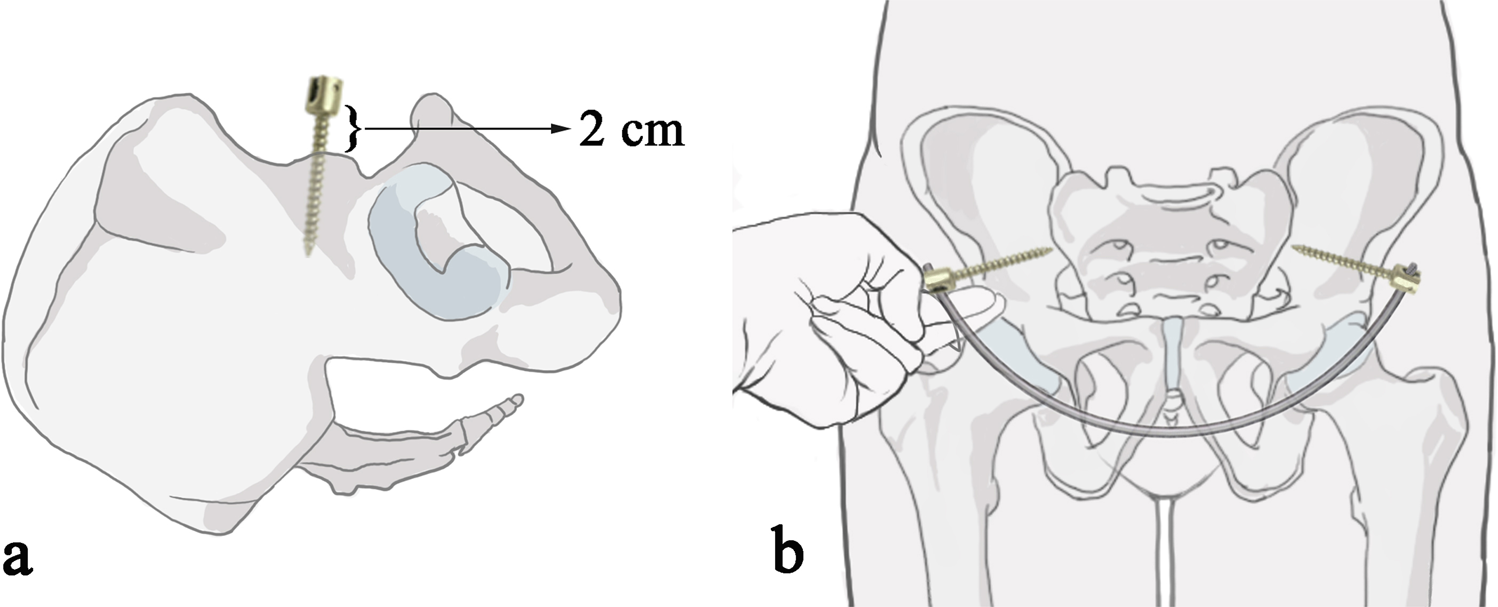 Anterior subcutaneous internal fixator (INFIX) versus plate fixation for  pelvic anterior ring fracture | Scientific Reports