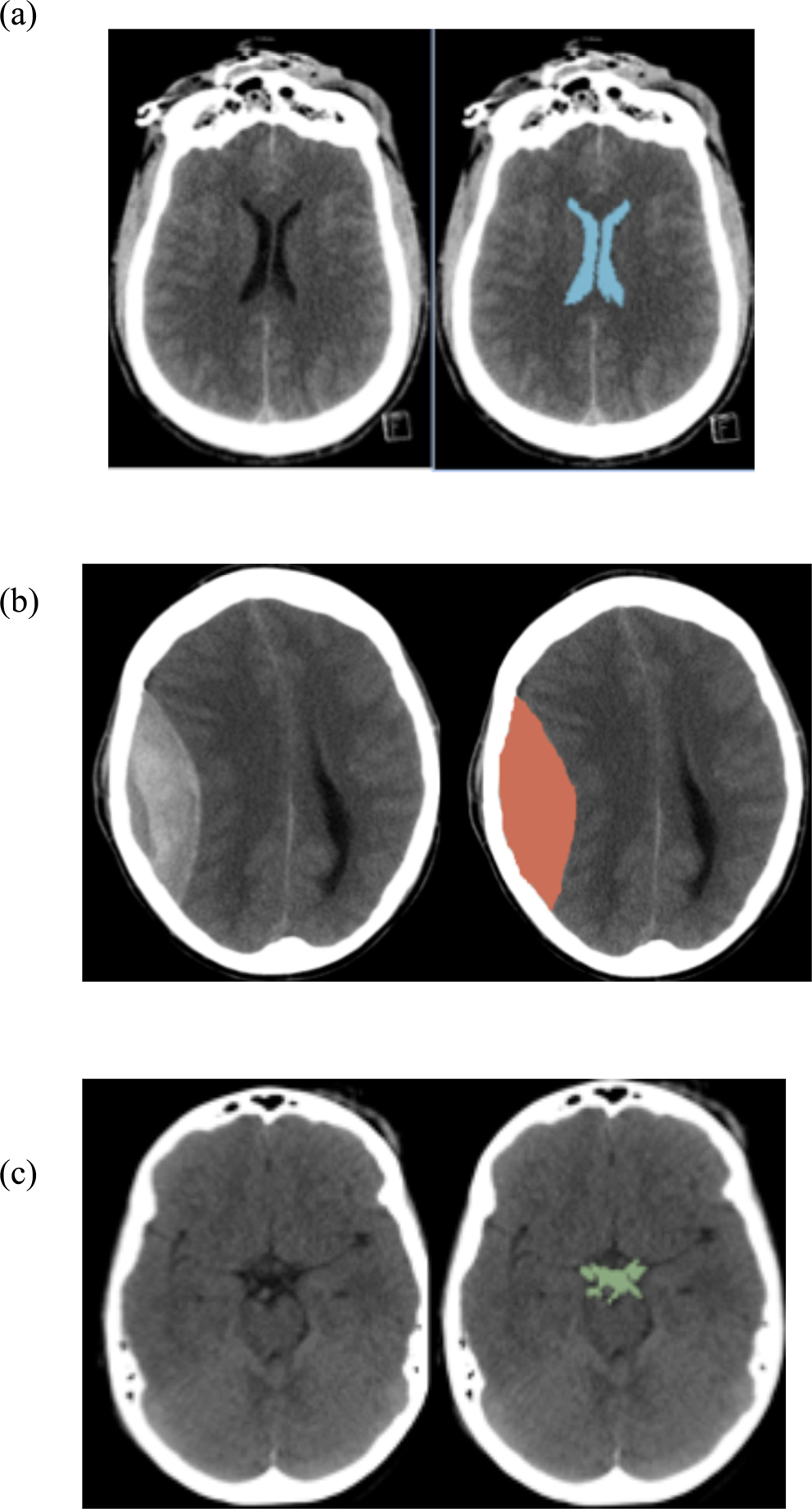 PDF) Microhemorrhage Pathology in Traumatic Brain Injury (TBI): Clinical  and Radiologic Features