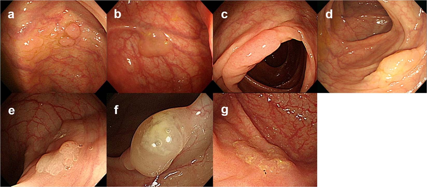 Clinical and endoscopic characteristics of sessile serrated adenomas/polyps  with dysplasia/adenocarcinoma in a Korean population: A Korean Association  for the Study of Intestinal Diseases (KASID) multicenter study | Scientific  Reports