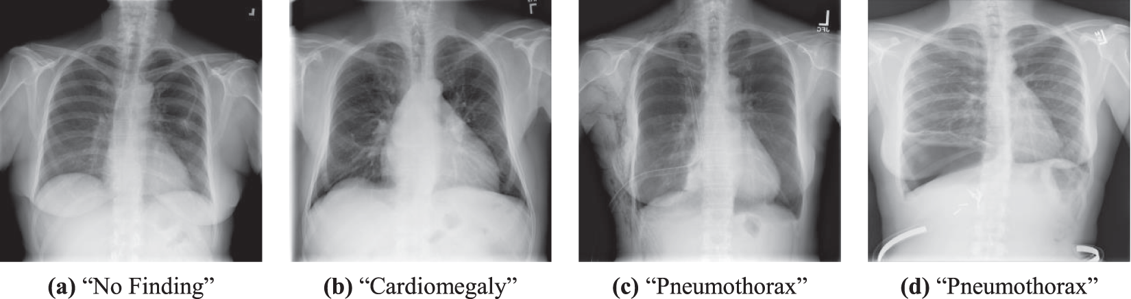 normal chest xray labeled