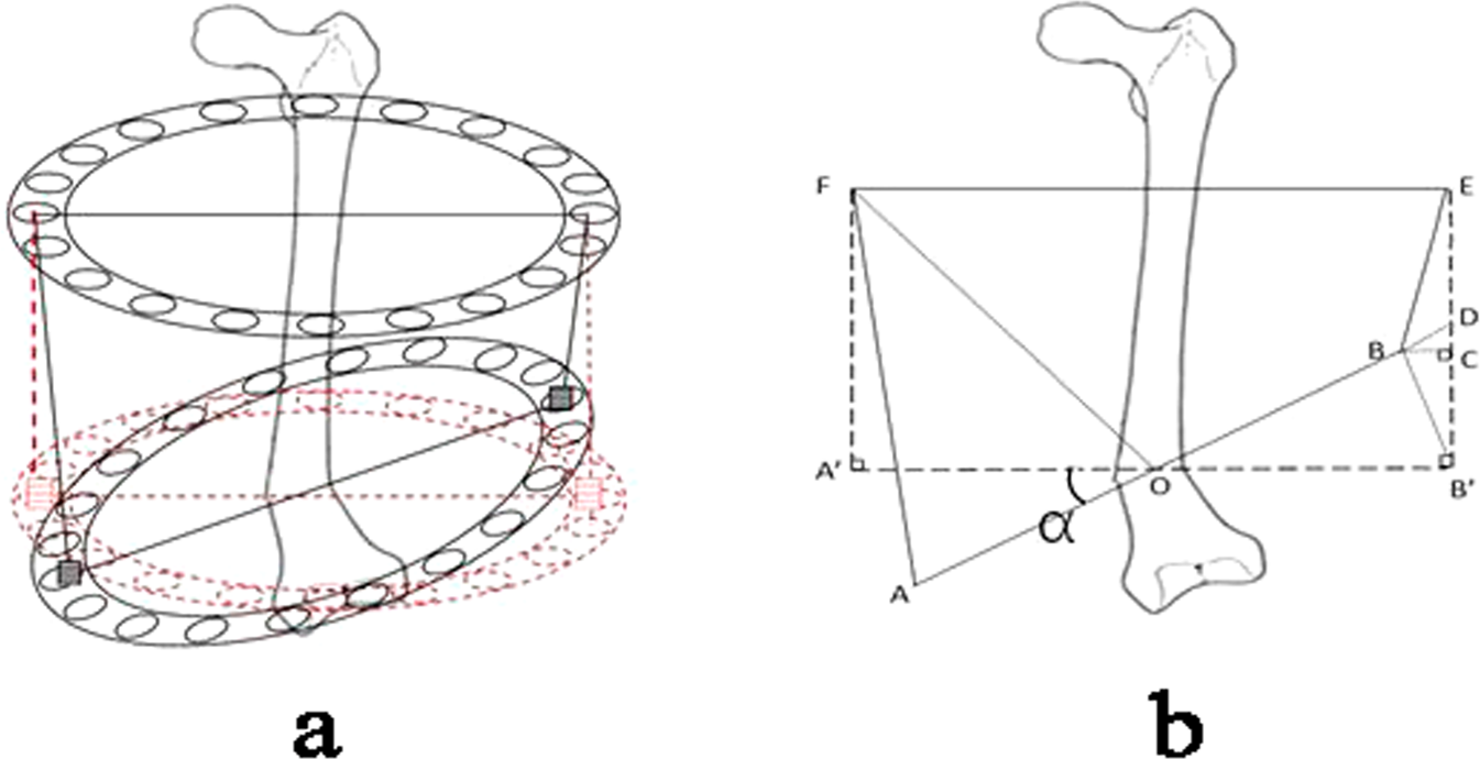 Figure 3 from Correction of genu recurvatum by the Ilizarov method.