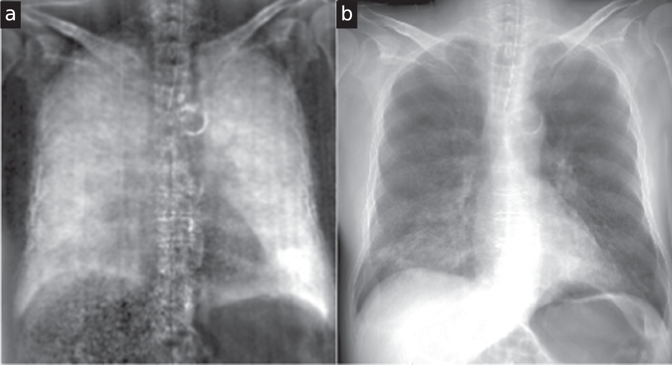 optimization-of-tube-voltage-in-x-ray-dark-field-chest-radiography-scientific-reports