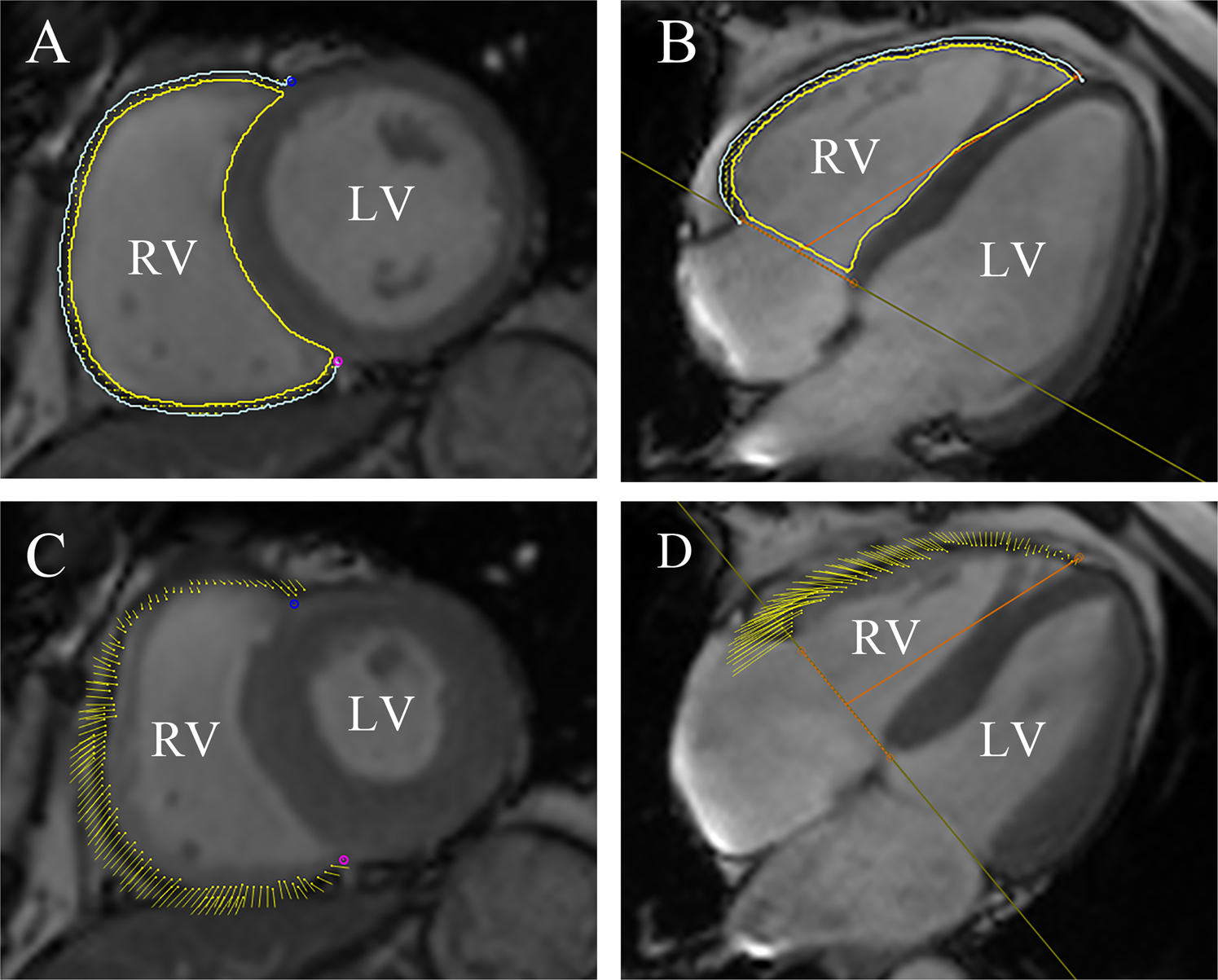 Reproducibility of 4D cardiac computed tomography feature tracking