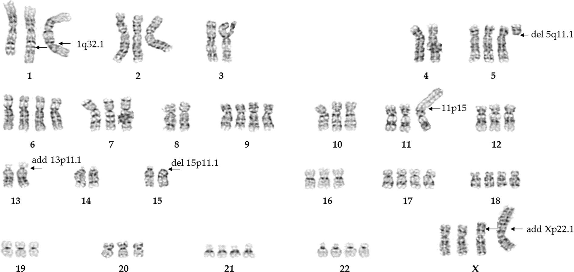 Ring chromosome 7: Report of the fifth case