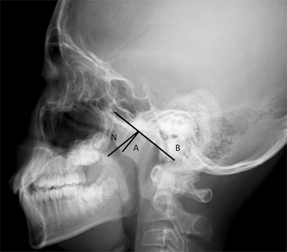 tonsillar hypertrophy score