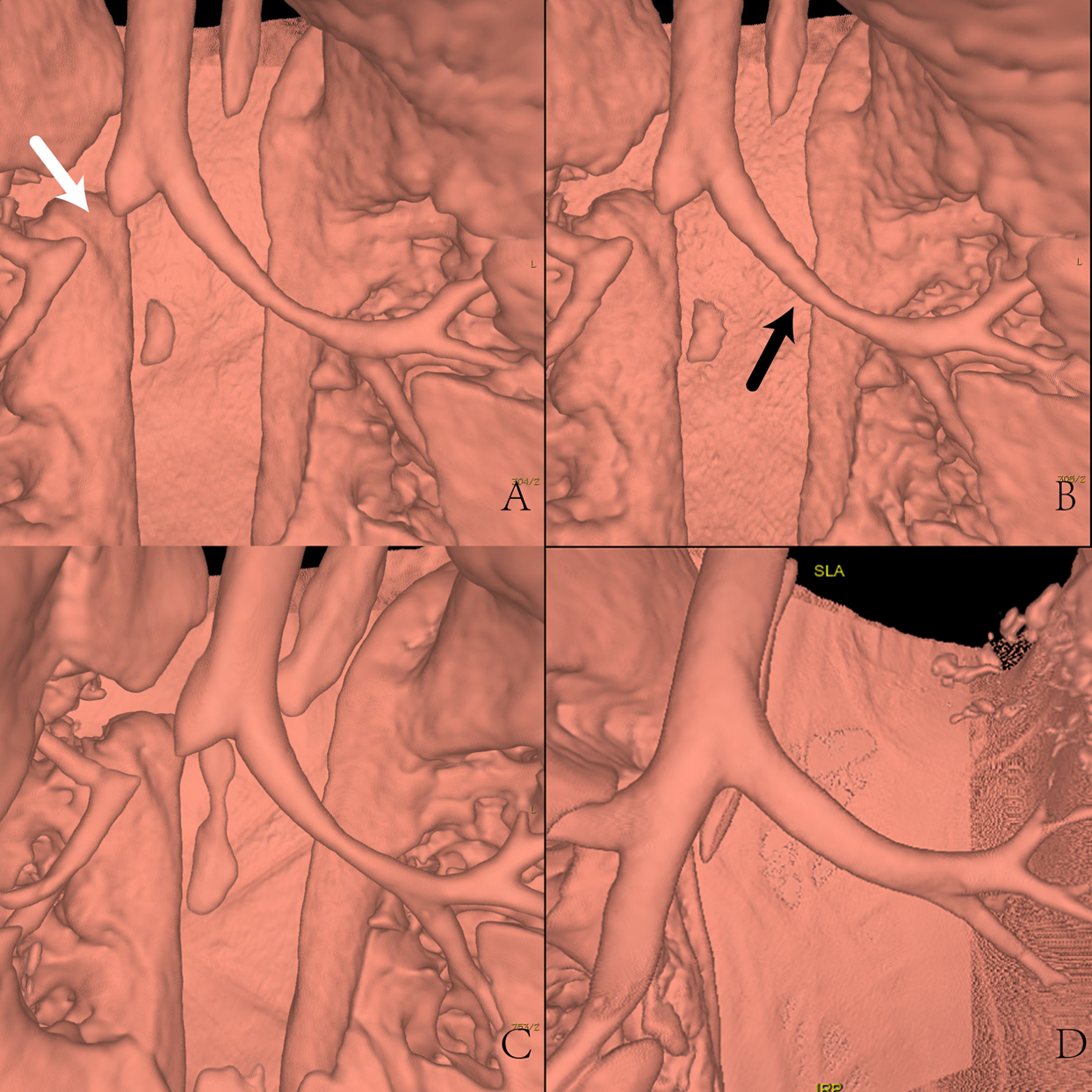 Feasibility Study Of Using One Tenth Msv Radiation Dose In Young Children Chest Ct With 80 Kvp And Model Based Iterative Reconstruction Scientific Reports Feasibility Study Of Using One Tenth Msv Radiation Dose In Young Children Chest Ct With 80 Kvp And Model Based Iterative Reconstruction Scientific Reports