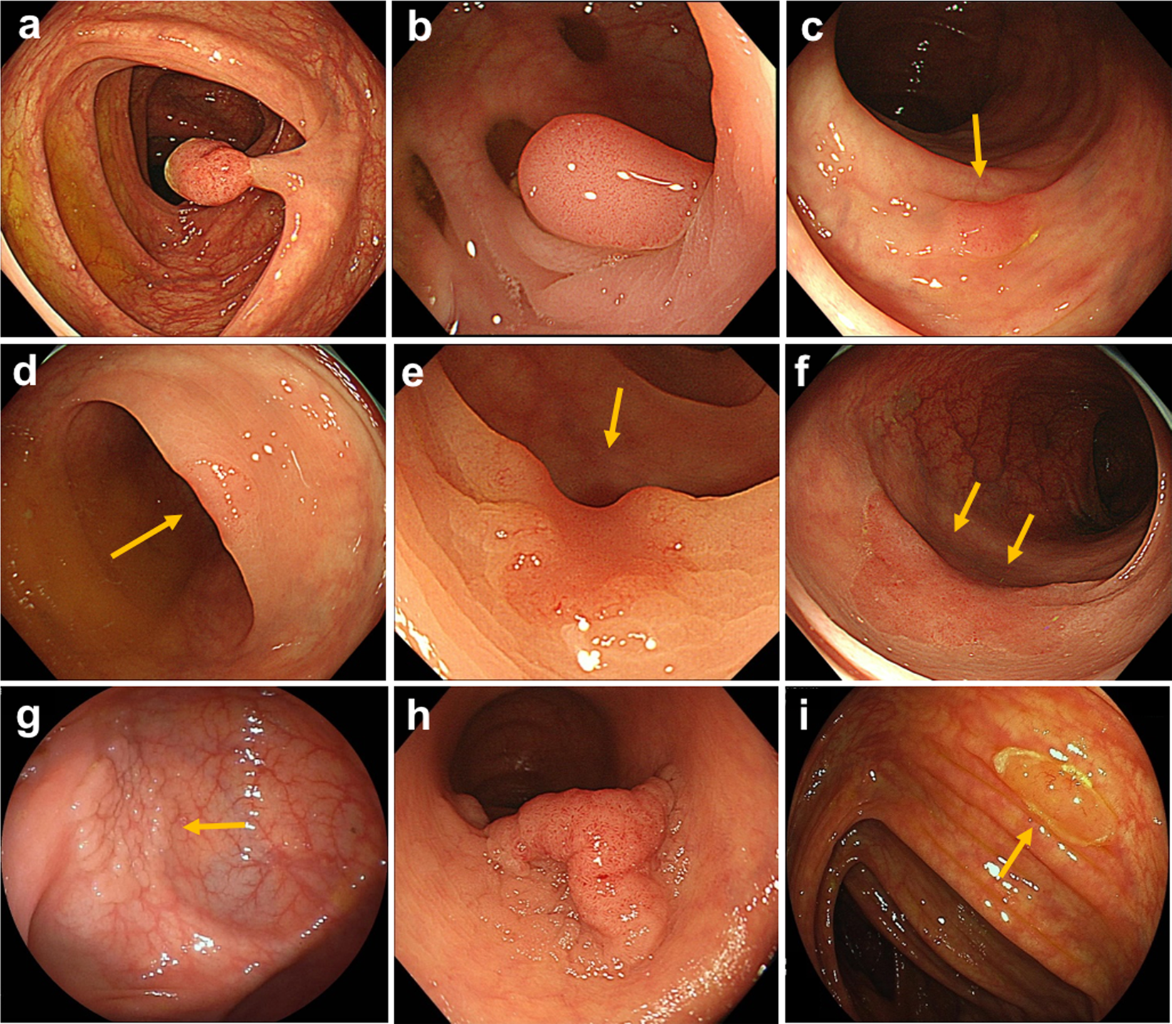 endoscopy for colon cancer