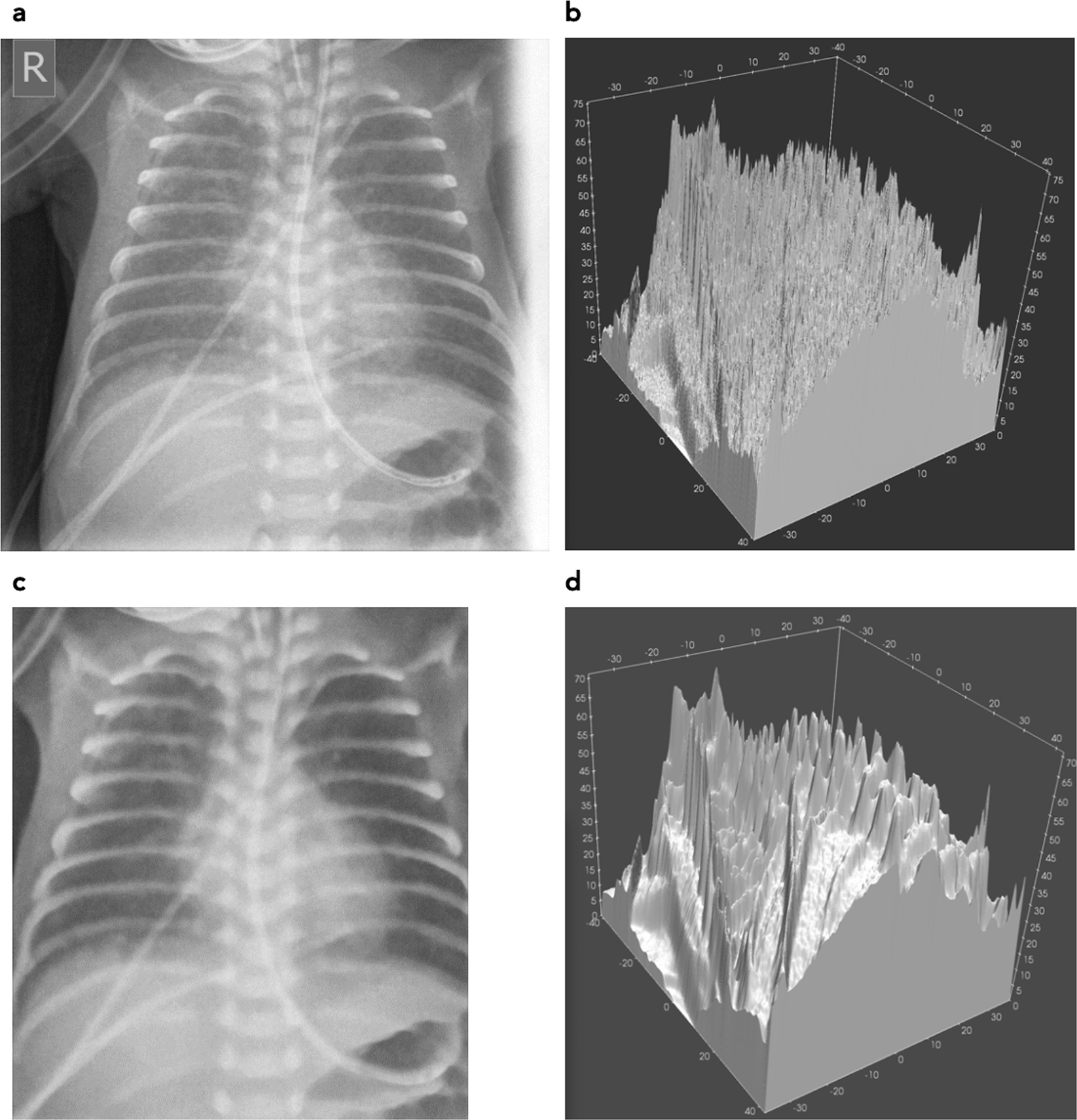 An Anthropomorphic Phantom Representing A Prematurely Born Neonate For Digital X Ray Imaging Using 3d Printing Proof Of Concept And Comparison Of Image Quality From Different Systems Scientific Reports