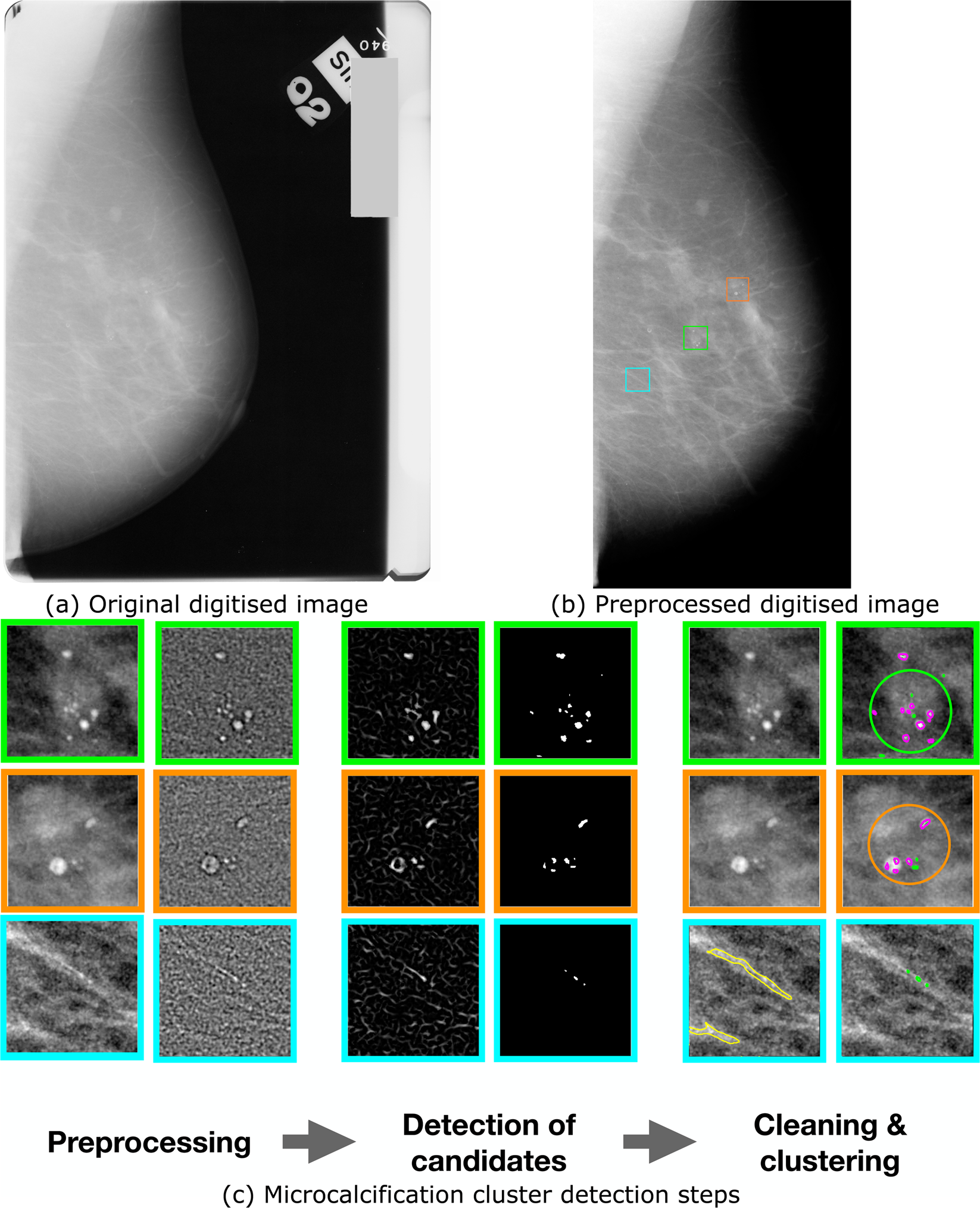 Association of Microcalcification Clusters with Short-term Invasive Breast  Cancer Risk and Breast Cancer Risk Factors