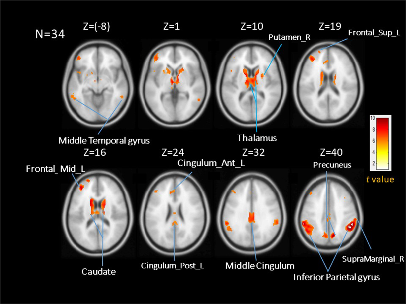 The effect of anxiety on brain activation patterns in response to  inspiratory occlusions: an fMRI study | Scientific Reports