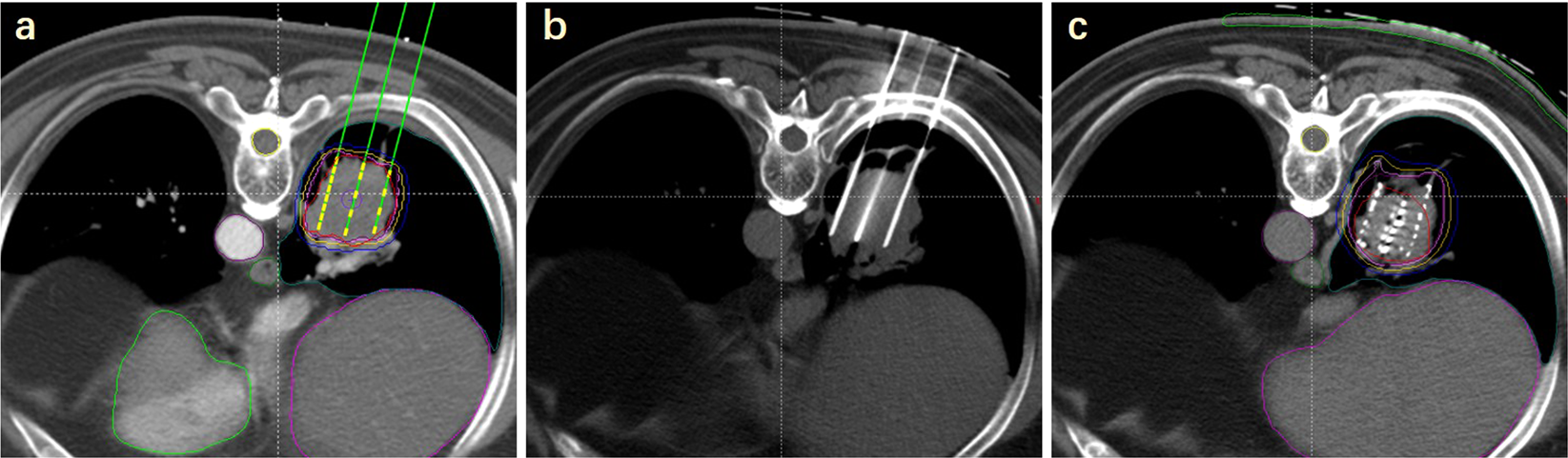 Localisation accuracy with iodine‐125 seed versus wire guidance for breast  cancer surgery - Ratnagobal - 2023 - Journal of Medical Radiation Sciences  - Wiley Online Library