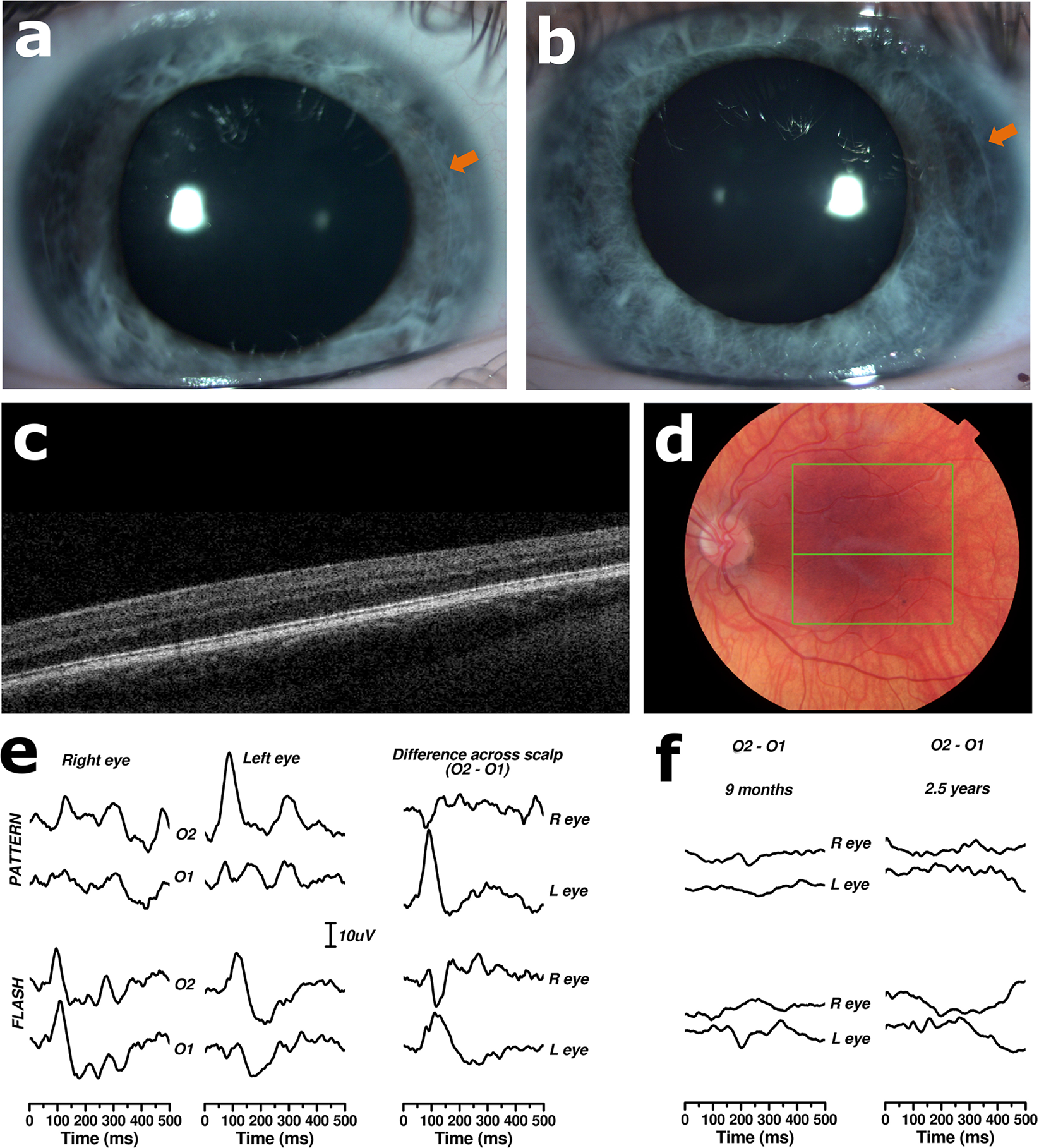 Clinical and genetic variability in children with partial albinism ...