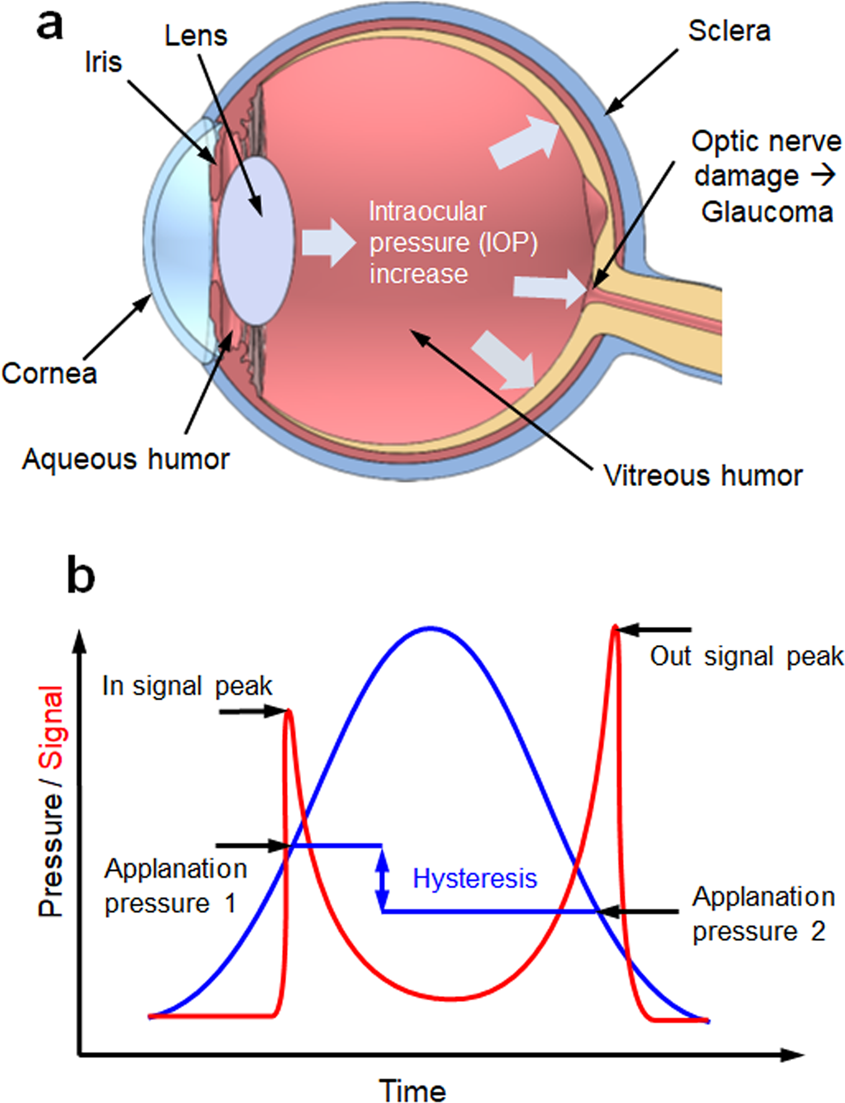 Working principle of the intraocular pressure (IOP) measurement using
