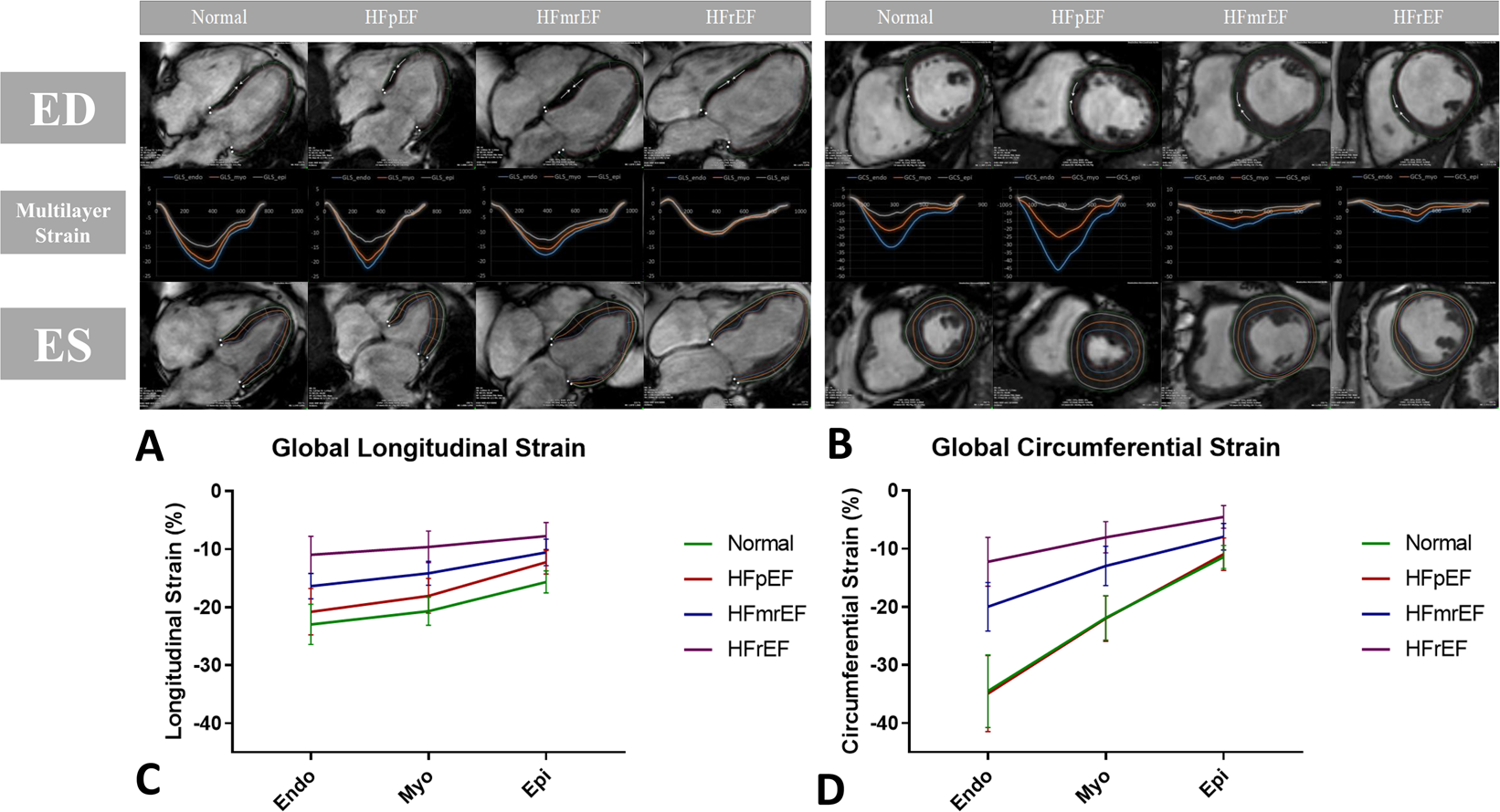 Distinct patterns of left ventricular regional longitudinal strain