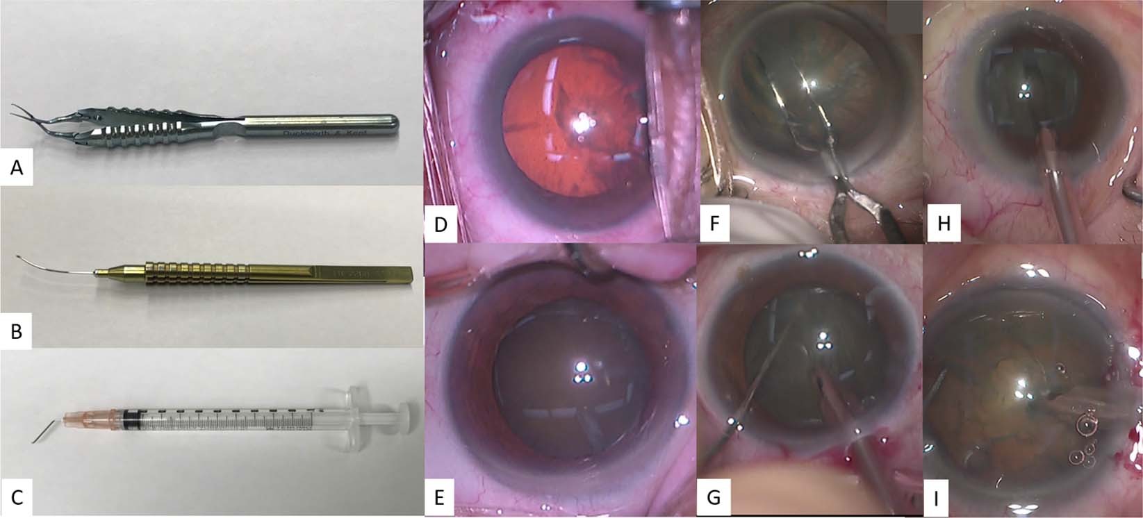 Real Time Extraction Of Important Surgical Phases In Cataract Surgery Videos Scientific Reports