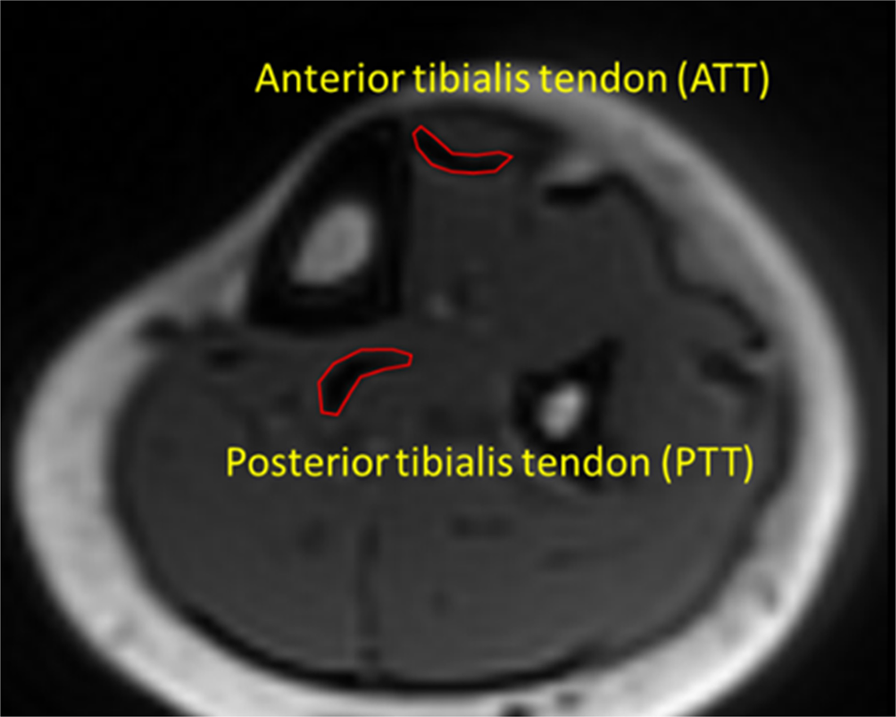 Age-related decrease in collagen proton fraction in tibial tendons  estimated by magnetization transfer modeling of ultrashort echo time magnetic  resonance imaging (UTE-MRI) | Scientific Reports