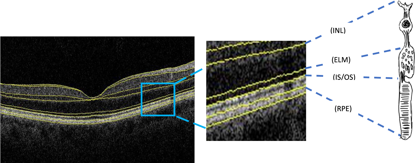 Layers of the Retina - Discovery Eye Foundation