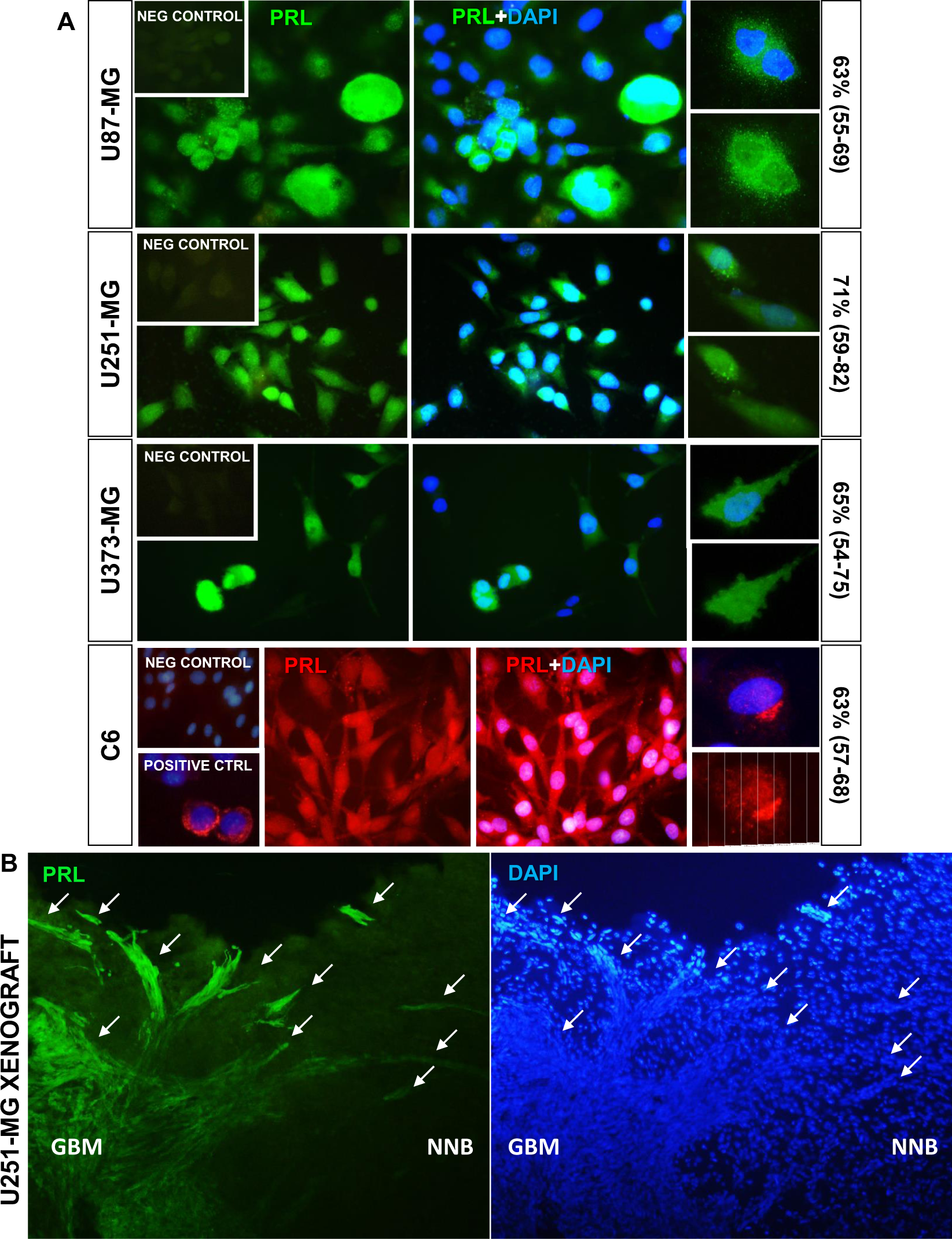 Prolactin and its receptor as therapeutic targets in glioblastoma  multiforme | Scientific Reports