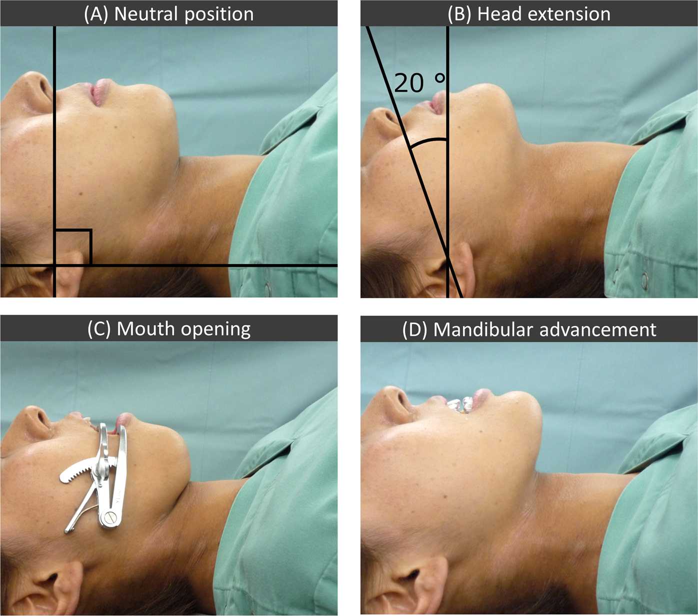 Supine position for casting