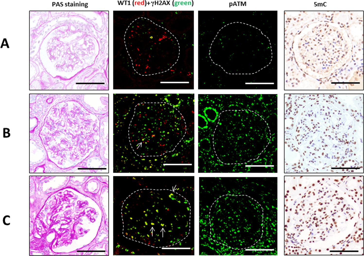 Association Of Glomerular Dna Damage And Dna Methylation With One Year Egfr Decline In Iga Nephropathy Scientific Reports