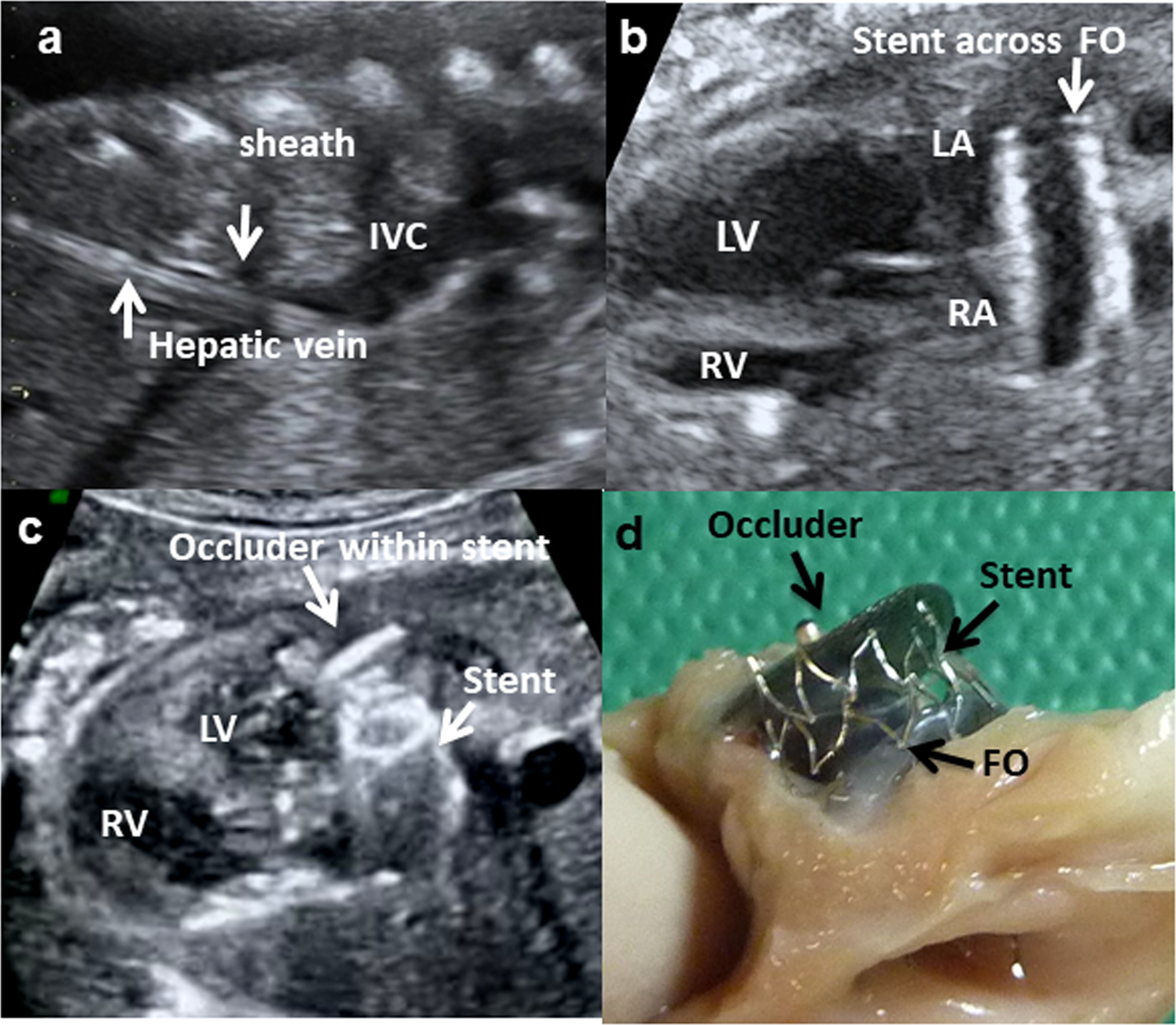 Induction of left ventricular hypoplasia by occluding the foramen ovale in  the fetal lamb | Scientific Reports
