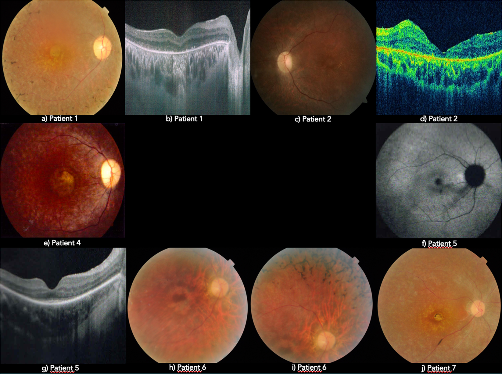 people with retinitis pigmentosa