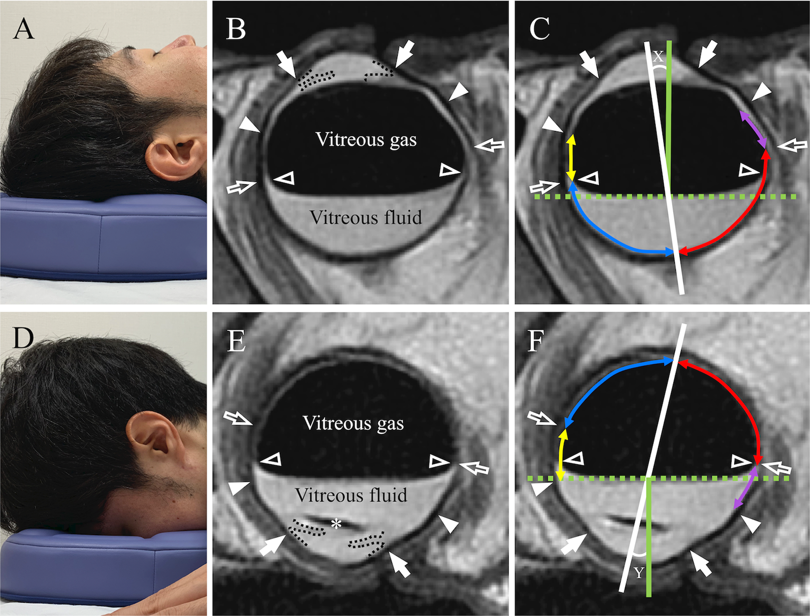 Evaluation of intraocular gas using magnetic resonance imaging after pars  plana vitrectomy with gas tamponade for rhegmatogenous retinal detachment |  Scientific Reports