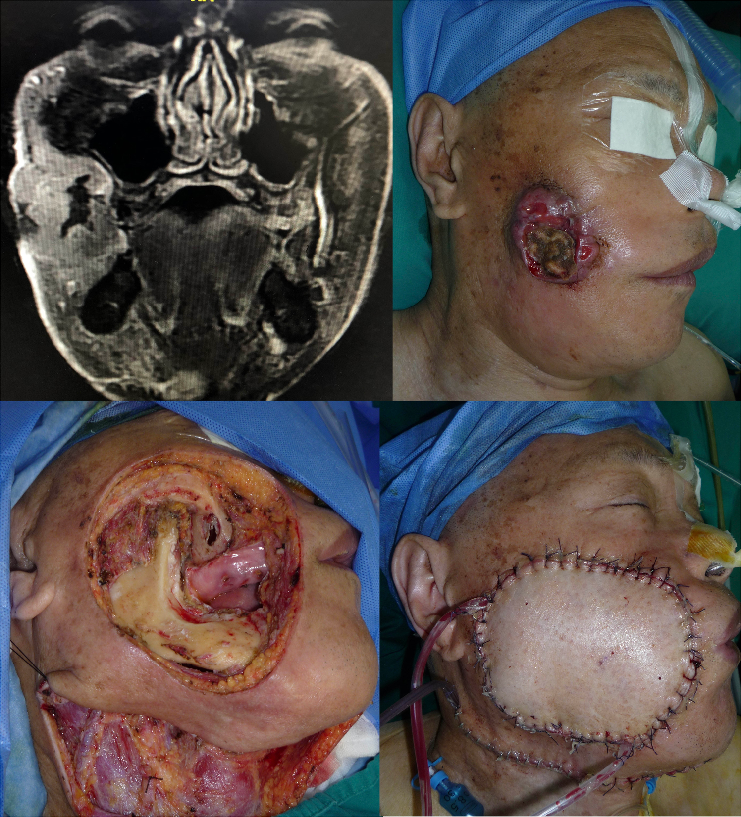 Reconstruction Of Composite Oral And Maxillofacial Defects By Free Flaps Based On A New Classification Scientific Reports